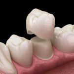 Bị tụt lợi chân răng có bọc răng sứ được không?