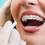 Bị tụt lợi có niềng răng được không?