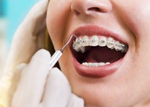 Bị tụt lợi có niềng răng được không?