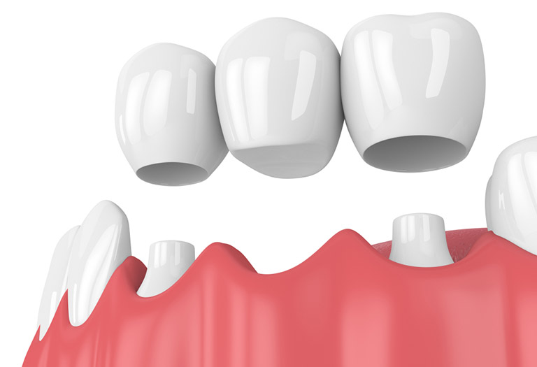Bắc cầu răng sứ là gì