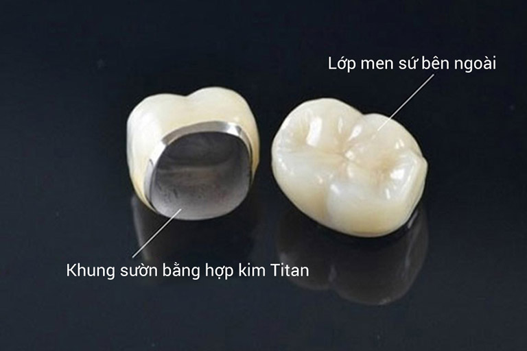 Bọc răng sứ Titan 