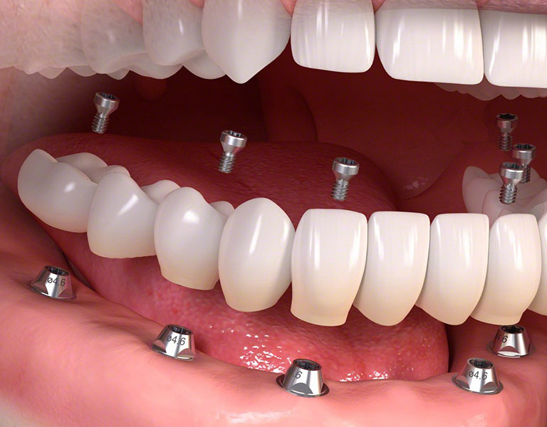 trồng răng implant all on 6