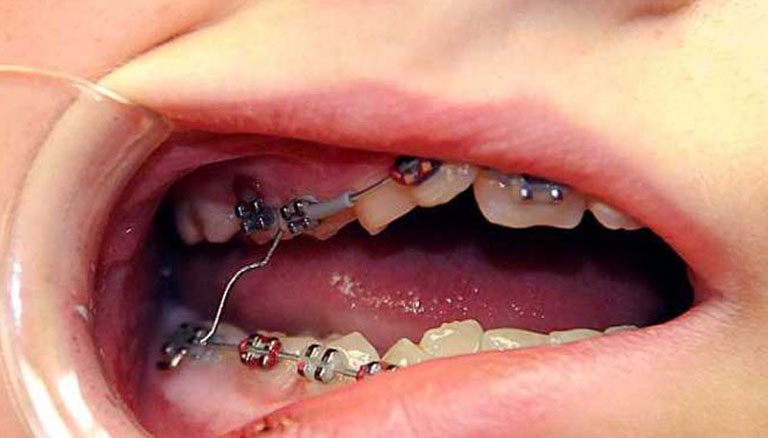 các loại dây cung niềng răng