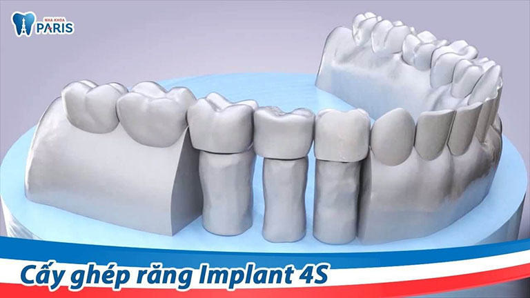 trồng răng implant ở đâu tốt tại hà nội trồng răng implant ở đâu tốt tại hà nội