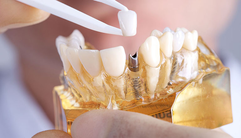 trồng răng implant ở đâu tốt tại hà nội