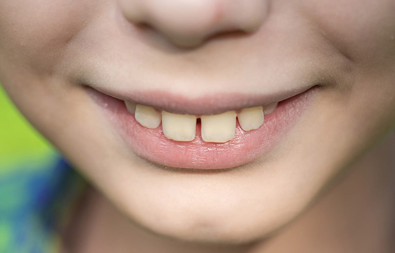 Đối tượng nào nên chọn niềng răng mắc cài kim loại