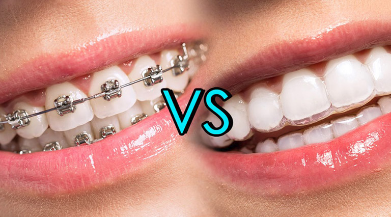 Đối tượng nào nên chọn niềng răng mắc cài kim loại