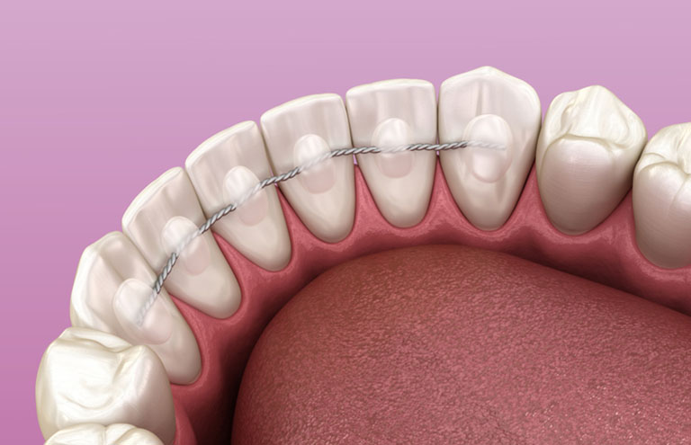 các loại hàm duy trì sau niềng răng