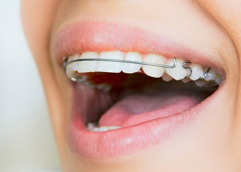 các loại hàm duy trì sau niềng răng