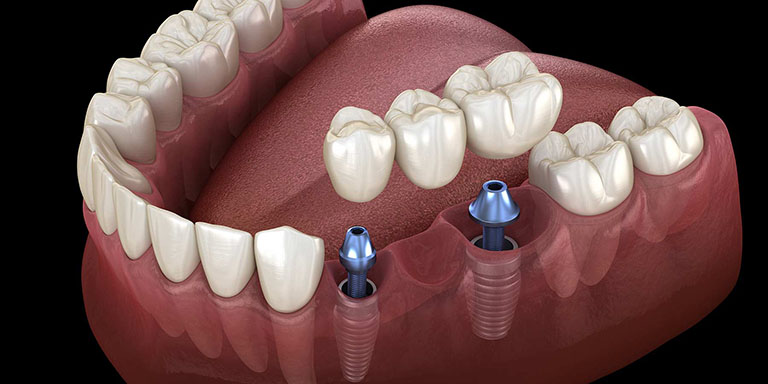 Nên làm cầu răng hay cấy ghép implant