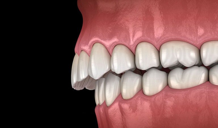 làm sao biết hô hàm hay hô răng