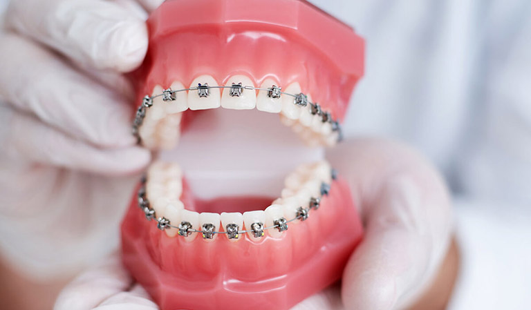 niềng răng có ảnh hưởng đến thần kinh không