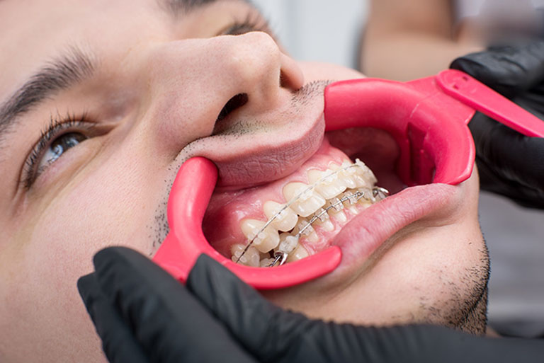 quy trình niềng răng mắc cài sứ tự buộc