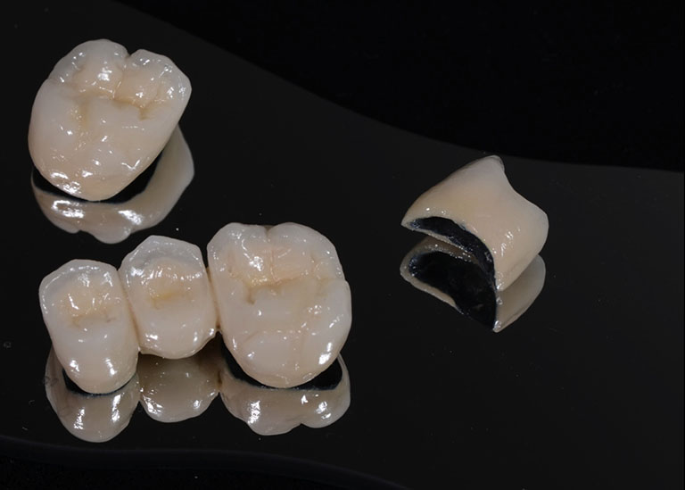 răng sứ kim loại là gì