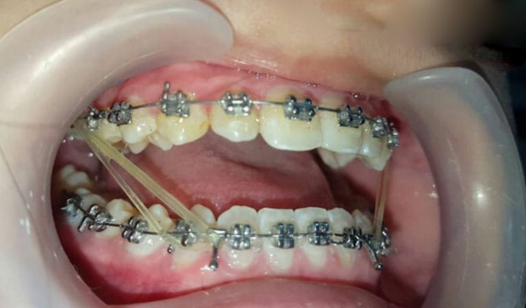 thun liên hàm niềng răng
