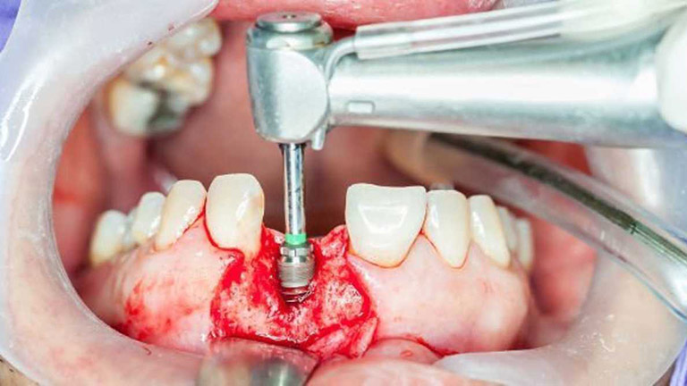 trồng răng implant có tốt không