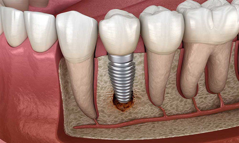biến chứng trồng răng implant