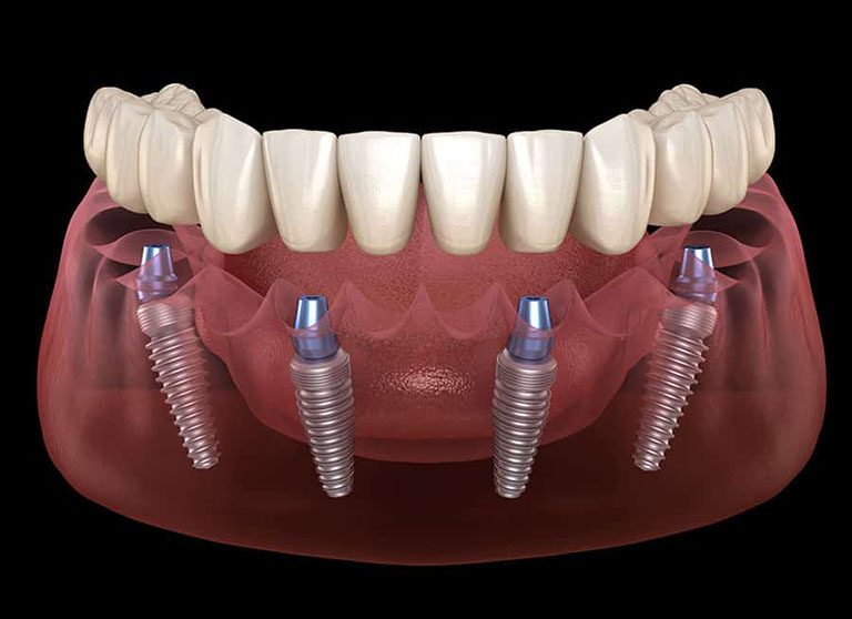 Trồng răng Implant nguyên hàm 