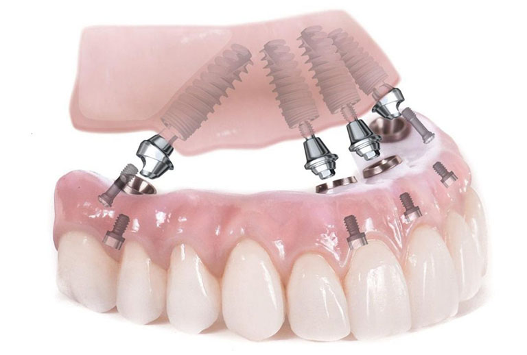 Trồng răng Implant nguyên hàm