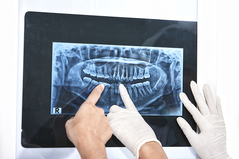 Trồng răng Implant nguyên hàm