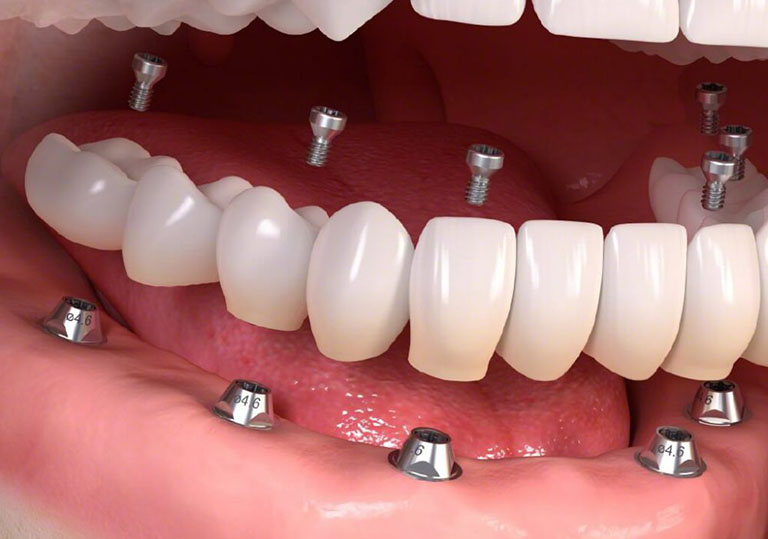 Trồng răng Implant nguyên hàm 