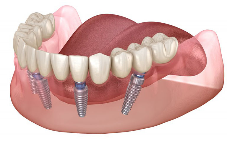 Trồng răng Implant nguyên hàm 