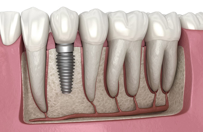 Trồng răng implant là gì