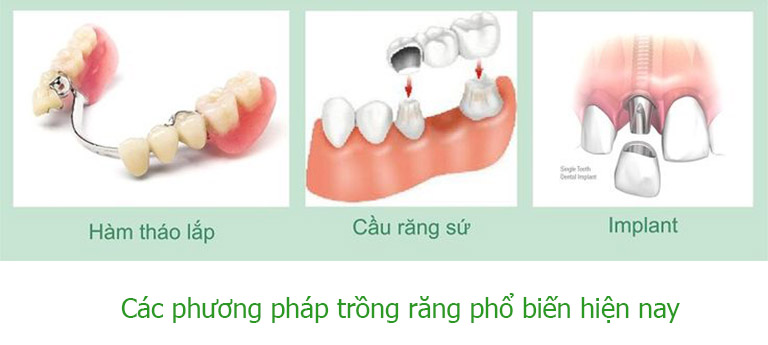 Trồng răng là gì