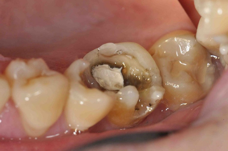 Có nên bọc răng sứ cho răng hàm không