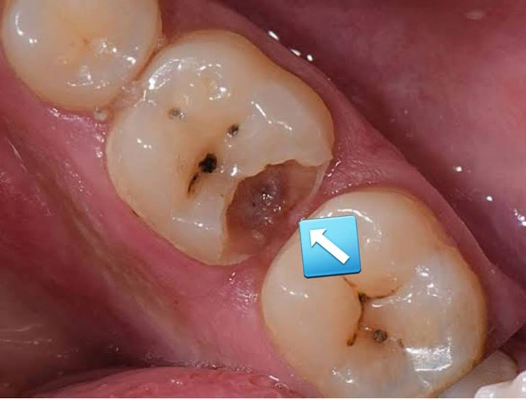 bọc răng sứ cho răng hàm không