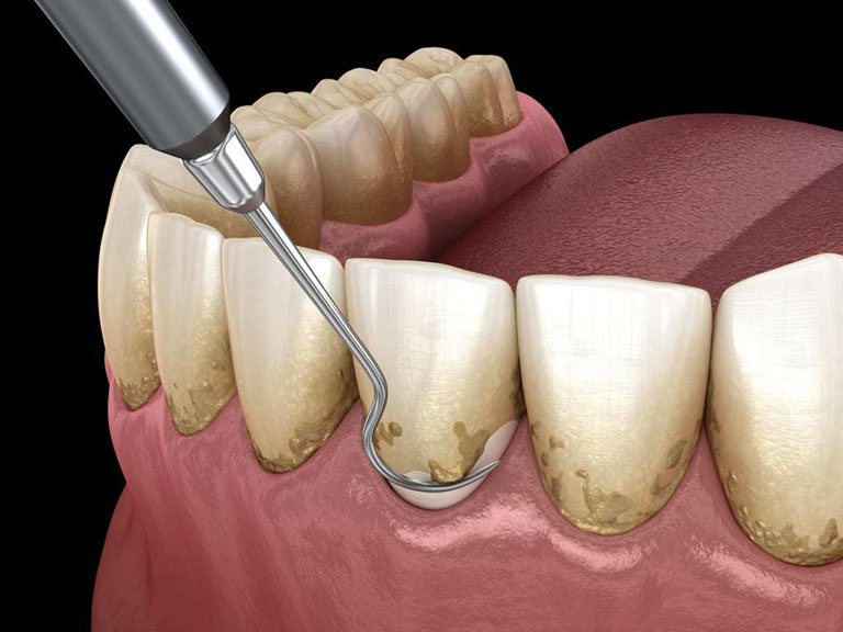 bọc răng sứ duy trì được bao lâu