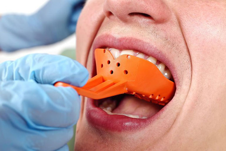 bọc răng sứ khắc phục móm