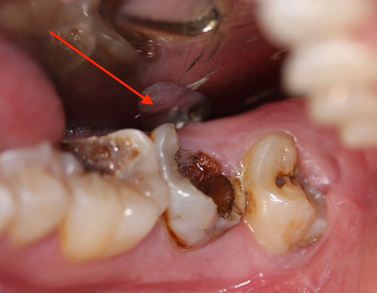 răng bị sâu chỉ còn chân răng có bọc sứ được không