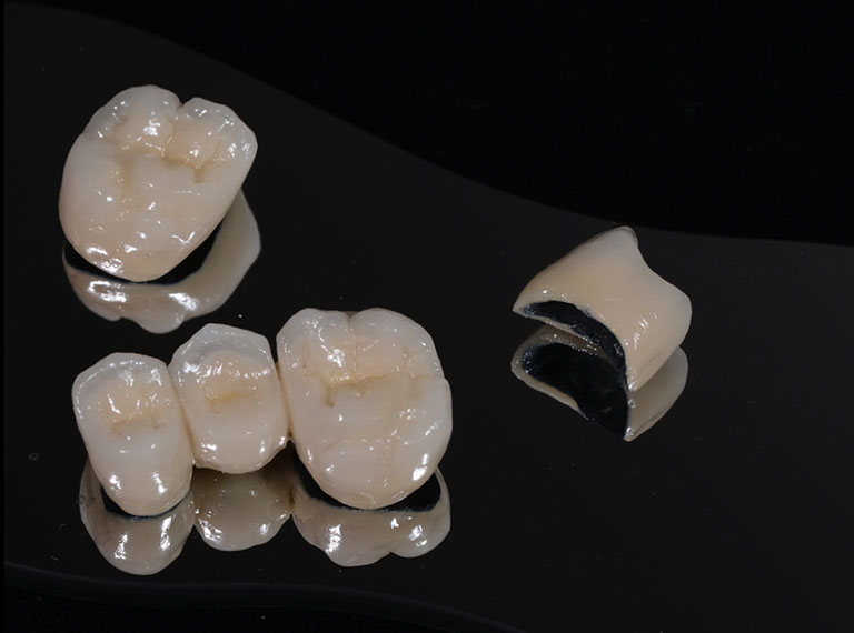 răng sứ titan là gì