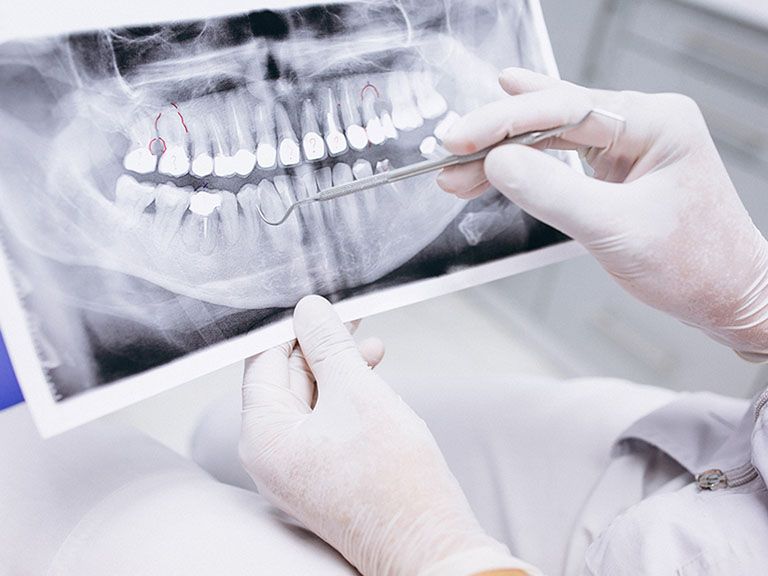 răng toàn sứ zirconia là gì