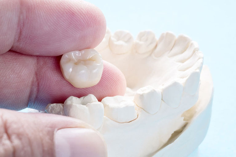 răng sứ kim loại và răng toàn sứ