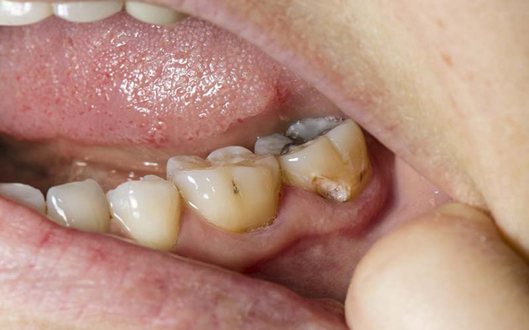 Tác hại của vôi răng