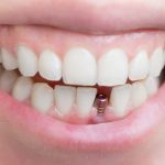 Trồng răng Implant giá bao nhiêu