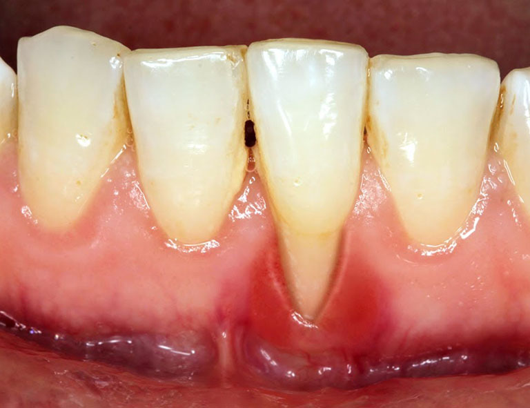 các bệnh thường gặp ở răng miệng