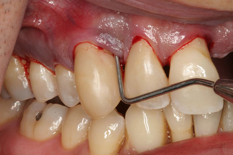 Các bệnh về răng miệng thường gặp