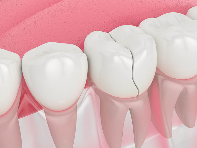 các bệnh thường gặp ở răng miệng