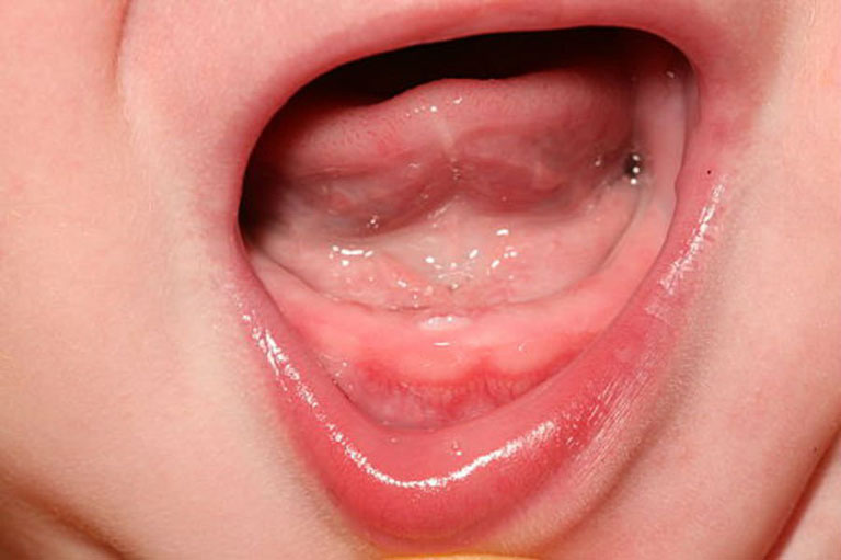 nguyên nhân dẫn đến trẻ chậm mọc răng