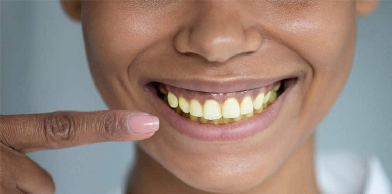 răng ố vàng là bệnh gì