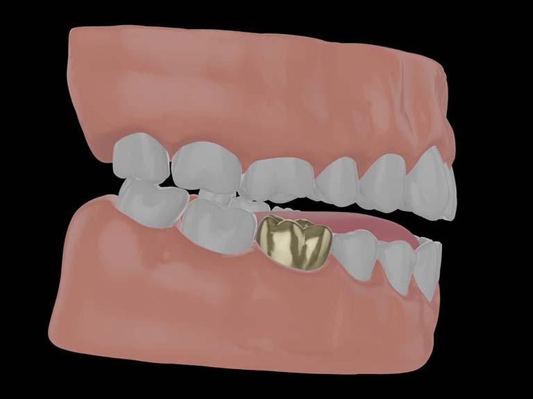 bọc răng hàm bị sâu