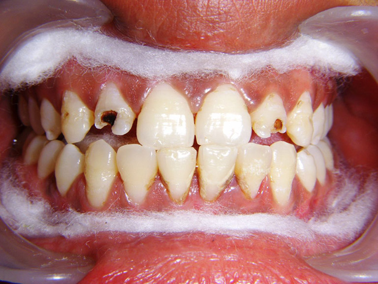 thiểu sản men răng