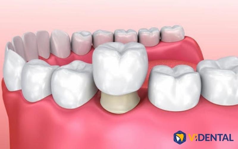 Bọc răng sứ là một trong những phương làm làm đẹp răng được nhiều người lựa chọn