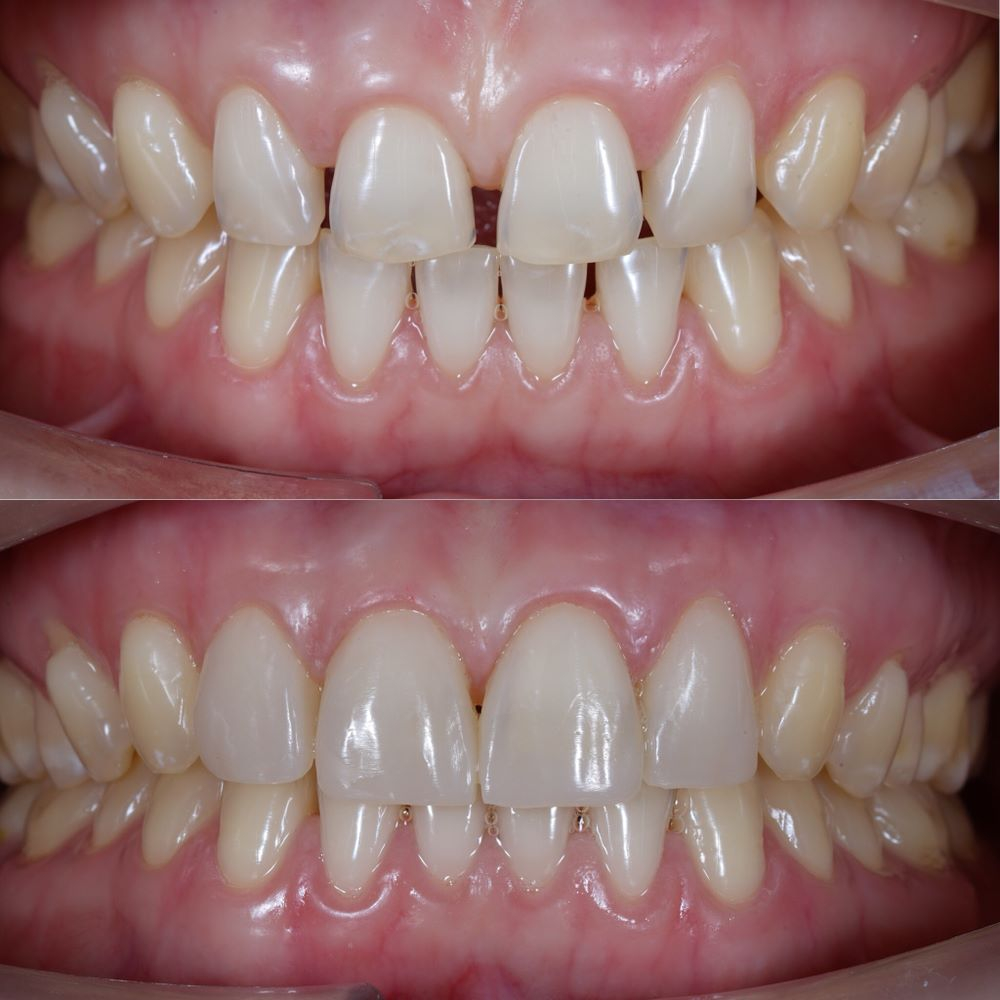 Tình trạng răng cải thiện hoàn toàn sau khi bọc sứ