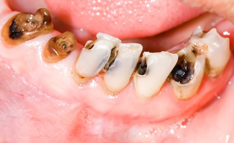 Bệnh nhân bị sâu răng nặng thường dễ bị buồn nôn lúc đánh răng