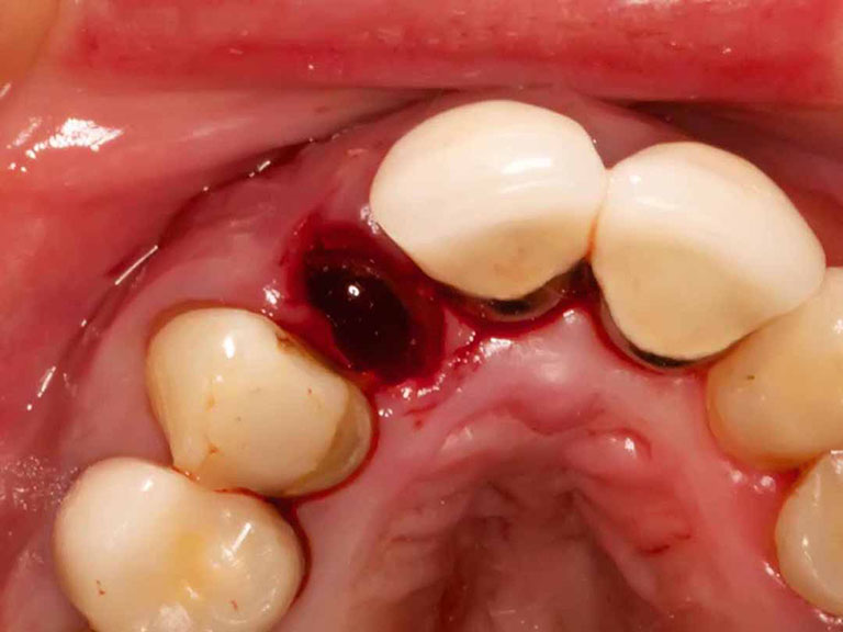 biến chứng khi nhổ răng
