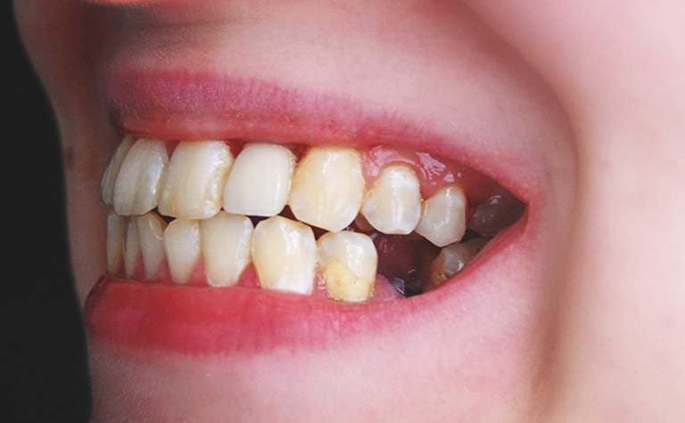 các biến chứng khi nhổ răng